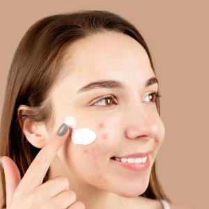 Young woman smiling while applying cream to acne-affected skin, promoting skincare routine.